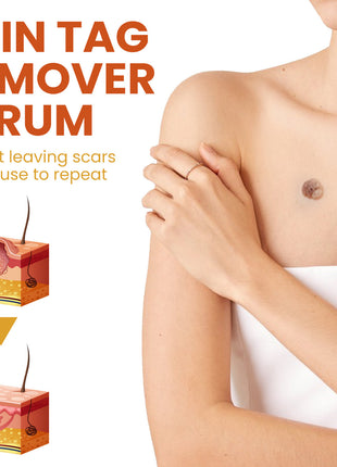 OUHOE Skin Wart Remover