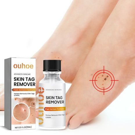 OUHOE Skin Wart Remover