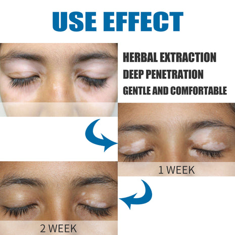 South Moon Skin Spot Removal Cream