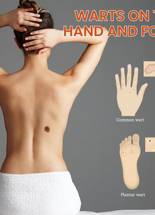OUHOE Skin Wart Remover