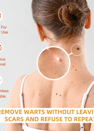 OUHOE Skin Wart Remover